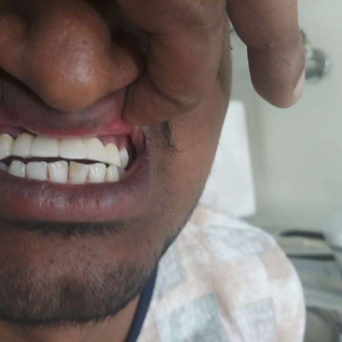 after treatment for deep bite
